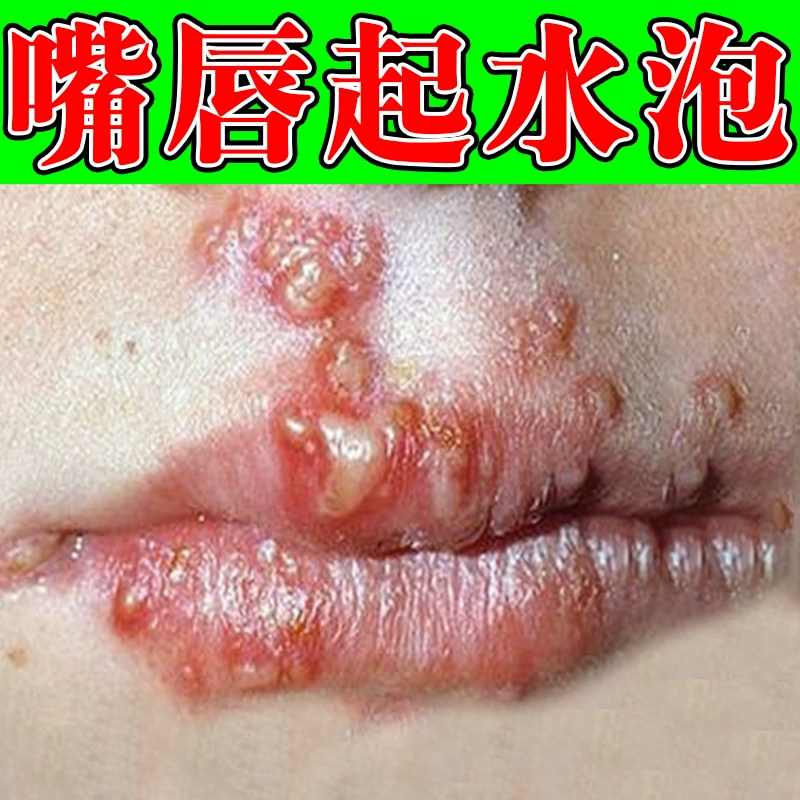 嘴角起泡口唇膏儿童成人嘴巴上火起泡烂红肿干燥开裂修复羊胡子疮