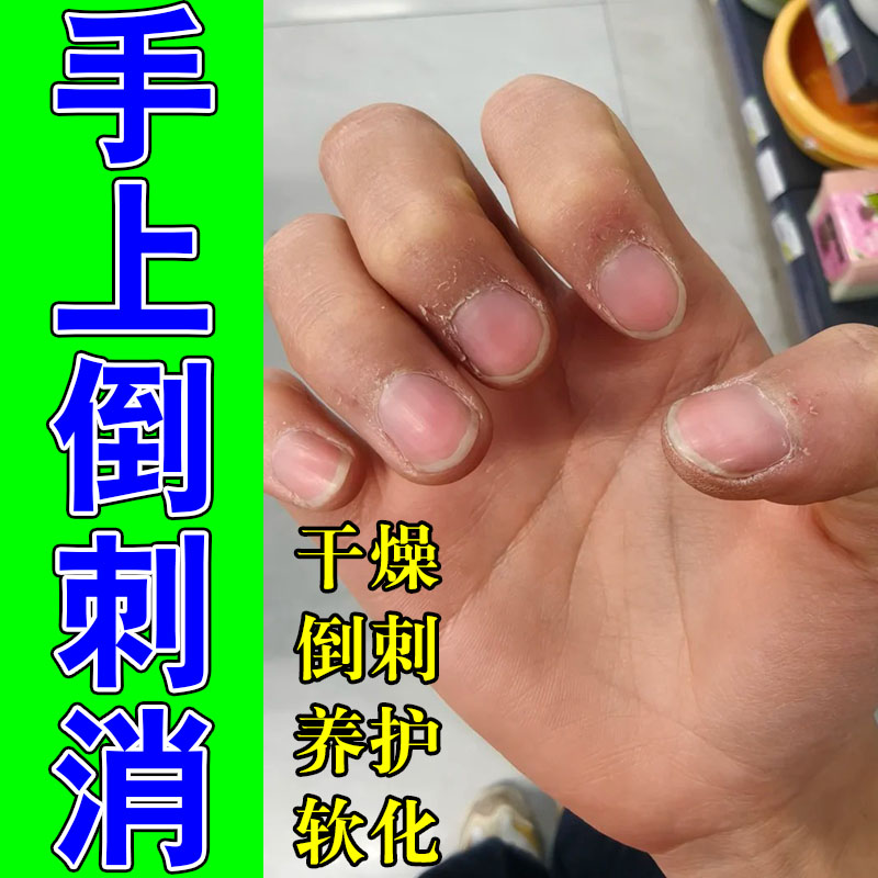 手指倒刺草本膏乳儿童修复护理有肉刺指甲边缘起皮防倒刺保湿膏