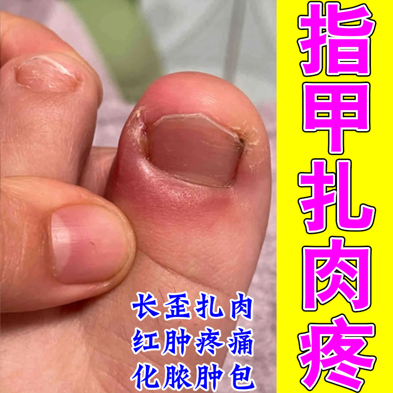 嵌甲甲沟修护草本膏改善指甲息肉红肿肿大干燥软甲脱皮疼痛乳膏