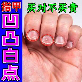 手指甲凹凸不平有凹坑修复液指甲盖凹陷萎缩分层受损再生