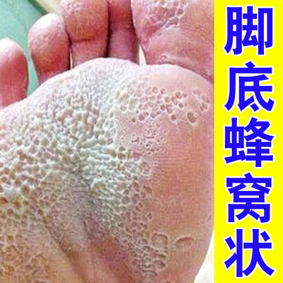 窝状角质松解症药脚底起泡蜂窝状沙虫脚糜烂脚发白发臭