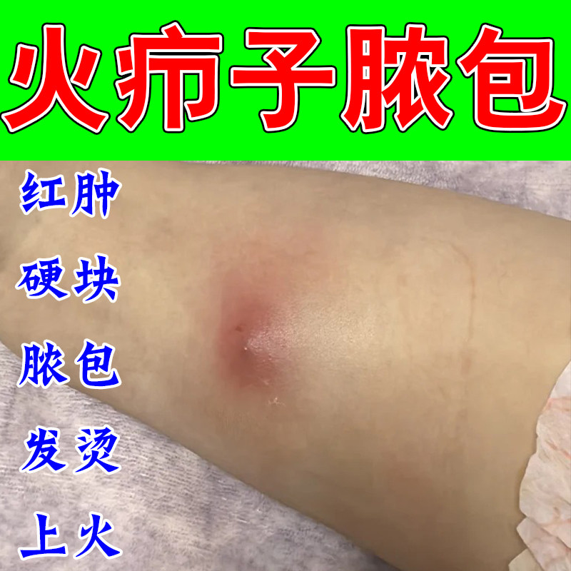 长火疖子脸上起硬块大包痘流脓化脓皮肤红肿疼拔脓修护舒缓膏