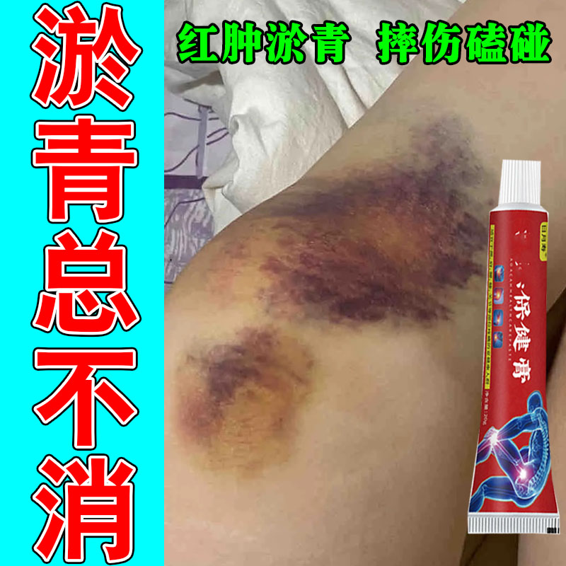 腿上淤青活除瘀化去血膝盖摔磕撞伤发紫跌损打伤外用淤青消膏