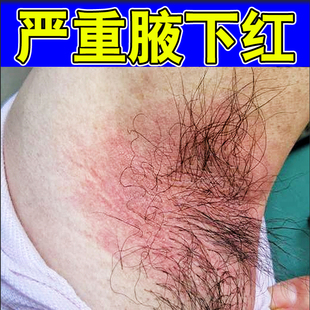 腋毛眼红白色附着物腋下红肿咯吱窝出汗腋窝清洁腋下红肿疼痛软膏