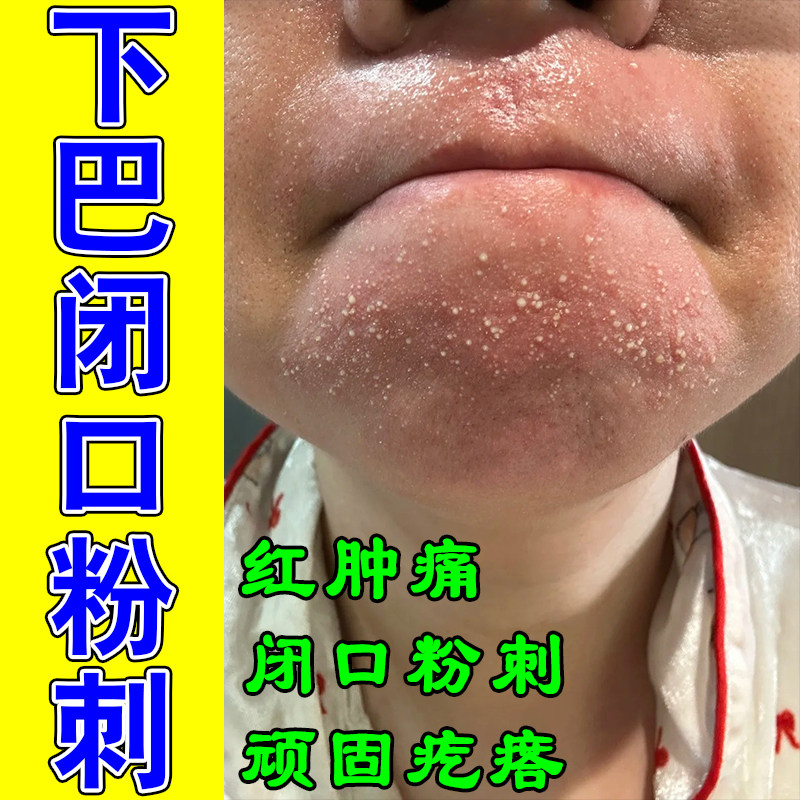 下巴长痘内分泌失调男女学生额头脸上包红肿硬块闭口粉刺修护膏