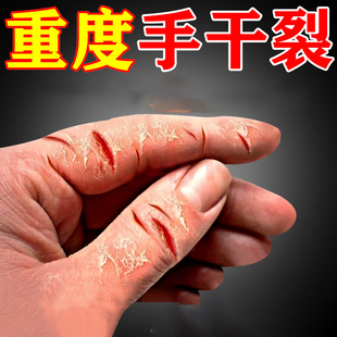 手裂口干裂修复秋冬季指甲缝干裂口蜕皮脚趾皲裂膏手指头裂口子