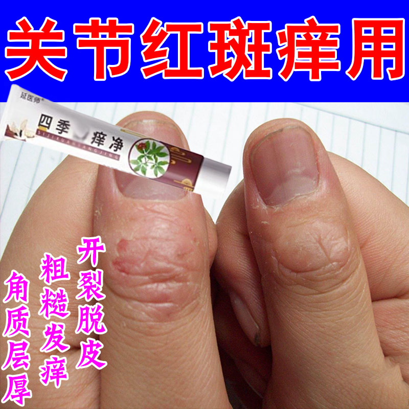 手指关节粗糙脱皮痒真菌长硬疙瘩硬块粗糙起皮关节发痒红肿草本膏