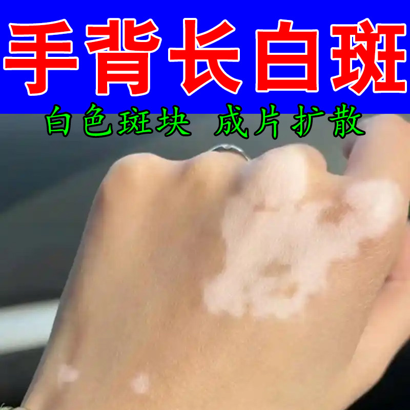 手上白斑专用黑色素生长外用修复手背身上皮肤长白色斑膏乳