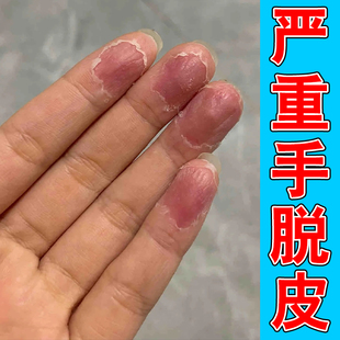 手脱皮手指头蜕皮干燥手掌干燥干裂手指手足蜕皮外用膏
