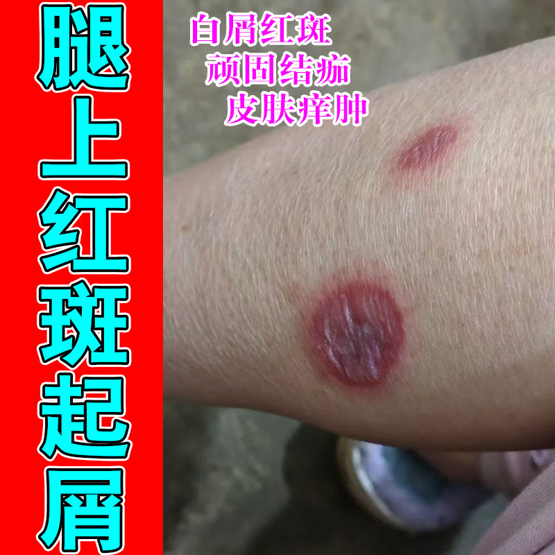 腿上屑痒红肿干皮干燥粗糙起屑抓挠草本萃取温和修护软膏