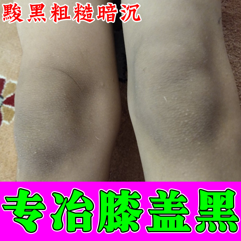 膝盖手肘关节黑棘皮粗糙暗沉色素发黑深层代谢黑色素沉淀按摩膏