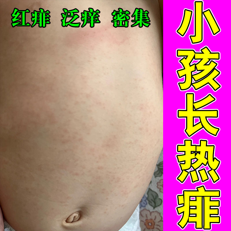 冶痱子痒痱成人热痱子疙瘩红大人儿童长菲子修护草本喷剂