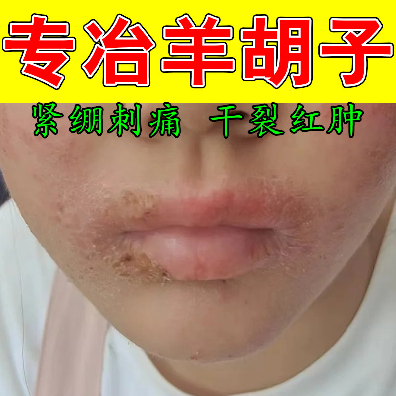 小孩爱舔嘴唇嘴周泛红干疼起泡起皮羊胡子植物萃取舒缓修护软膏