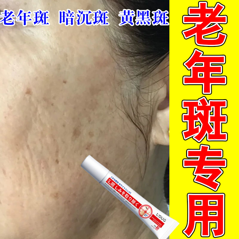 人老长黄斑脸上斑黑斑黄斑日晒黑点太阳斑暗沉黄斑草本萃取修护膏