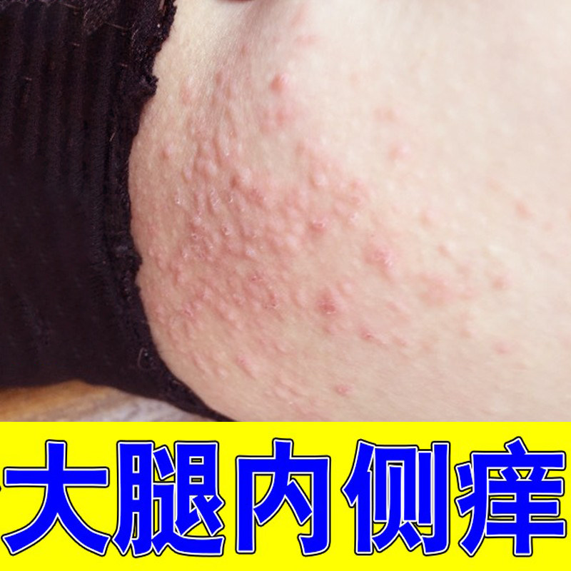 大腿根部内侧潮湿疙瘩皮肤红点红斑专用软膏