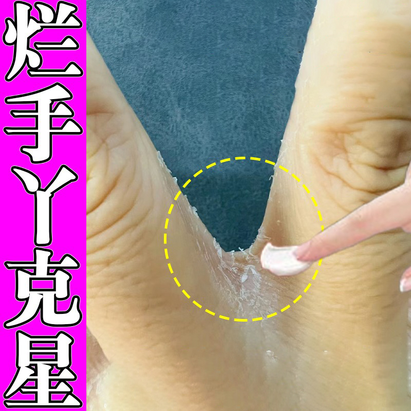 烂手丫手指缝溃烂开裂干裂手气脱皮起皮手指缝发红修复专用软膏