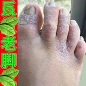 脚背脚起皮起皮脚背起干皮干燥出汗脚趾专用软膏