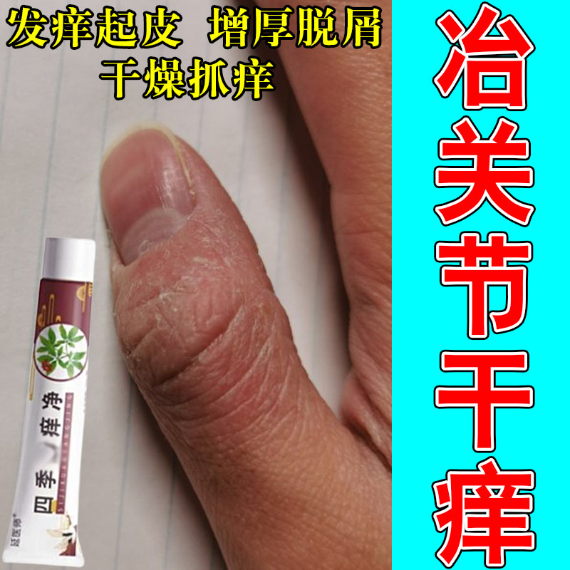手指关节真手指头粗糙脱皮长硬疙瘩手指脱皮痒粗糙红肿修护草本膏