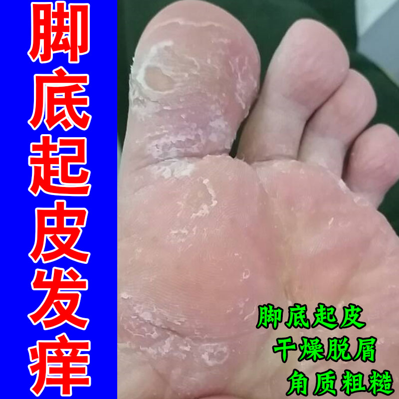 脚脱皮专用膏脚底板脚掌干燥掉皮蜕皮真菌脚发痒修护乳膏