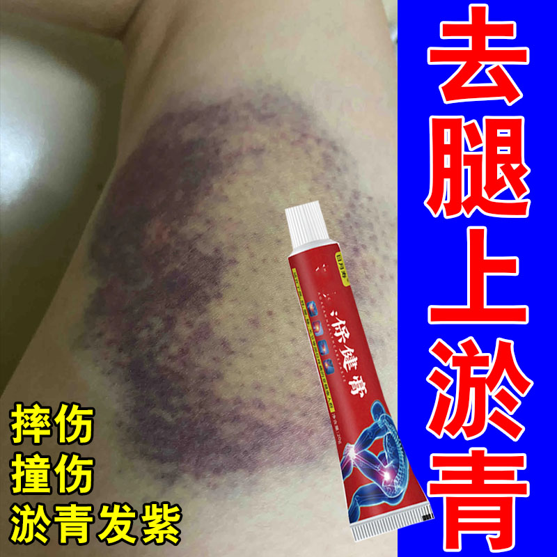 腿上撞伤淤青身上有瘀斑摔伤磕碰撞伤红肿发紫疼痛活血化瘀专用膏