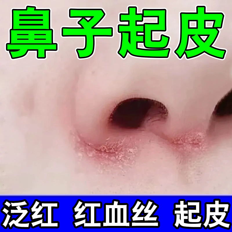 鼻子两侧发红起皮脱皮鼻翼两边泛红干燥长痘痘干痒膏酒糟鼻修复膏
