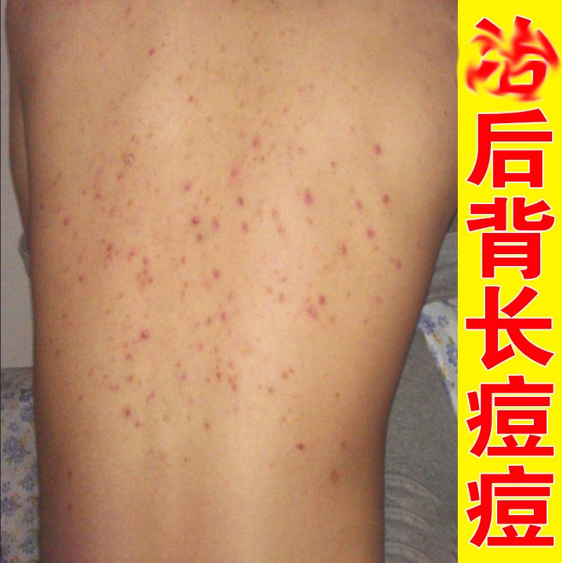背上胸前软膏淡化修复黑色素沉淀后背脖子除螨专用