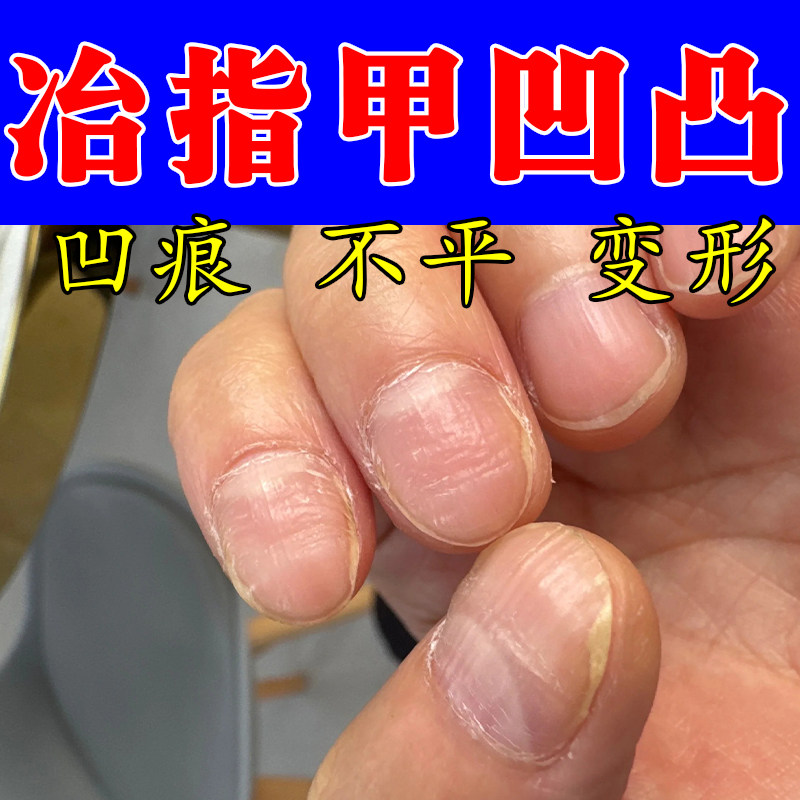 指甲凹凸不平修复液手脚指甲凹陷有竖纹分层甲床凹凸不平弯曲甲液