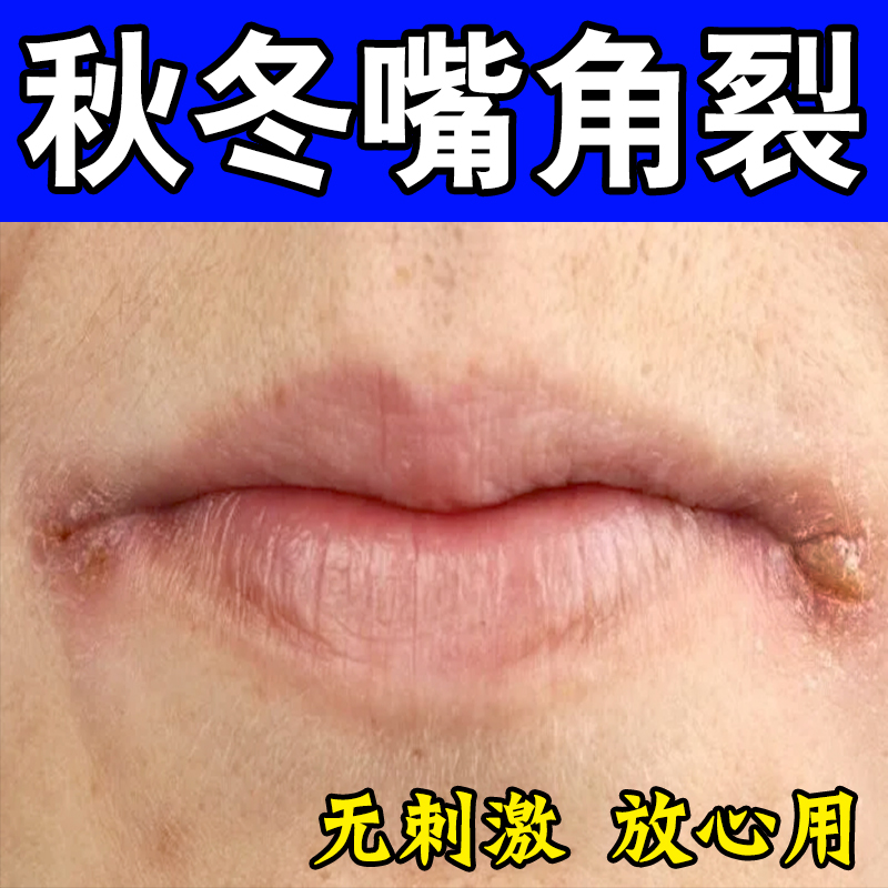 嘴角烂开裂唇炎润唇膏冶口角炎嘴唇角边开裂起泡上火修复专用唇膏