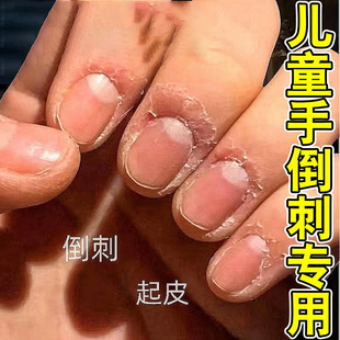 手指起倒刺修复受损儿童成人手上干裂脱皮去死皮肉刺疼专用护手霜