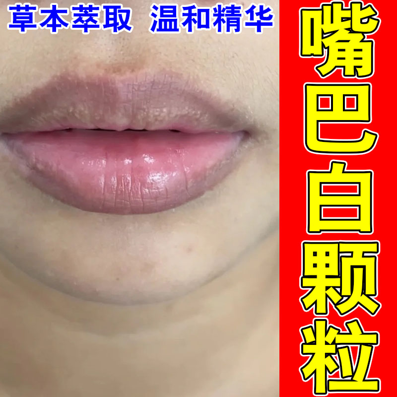 嘴唇皮脂腺异位唇部白点脂肪小颗粒脂肪粒白点增生修护草本乳膏