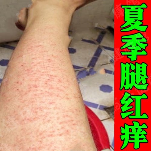 春天小腿皮肤起皮腿上长红点小腿红点疙瘩冶疗春夏季软膏