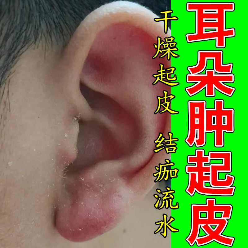 耳朵痒发痒起皮耳廓痒有皮屑结痂耳朵痒干燥耳起皮粗糙修复膏