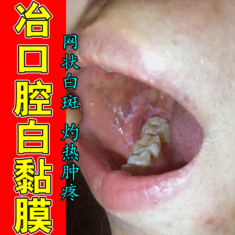 改善口腔扁平苔冶白斑黏膜修护扁平白斑纤维化修护草本喷剂