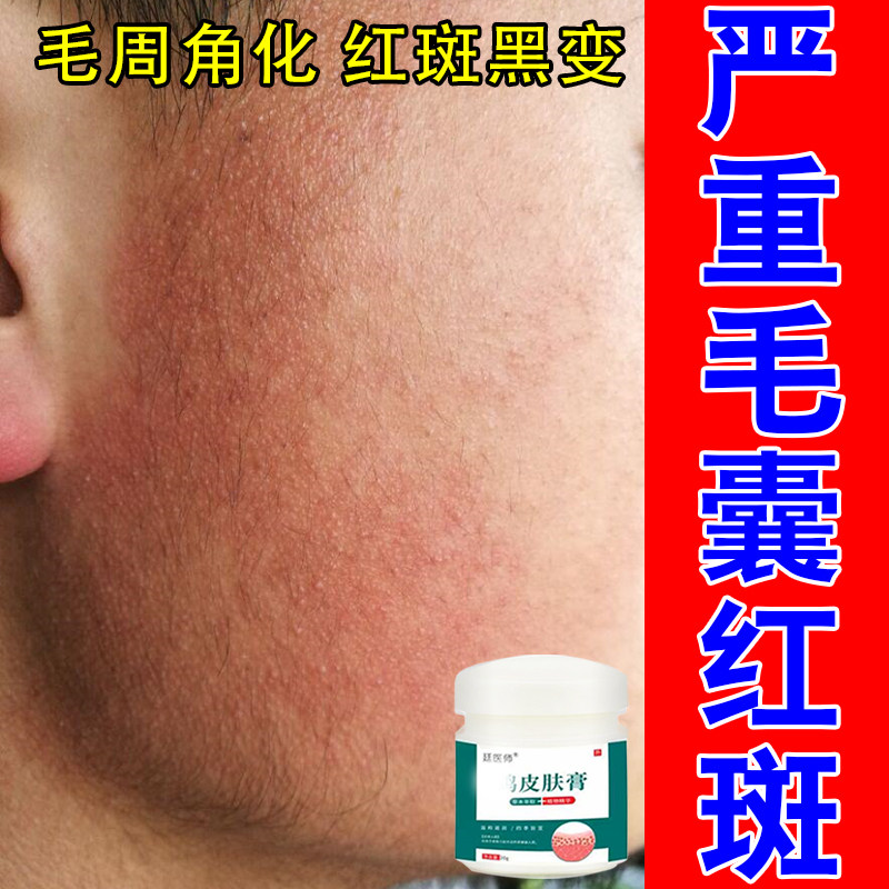 脸部毛囊红斑黑变粗糙疙瘩暗沉泛红改善草本修护膏面部暗沉发黑膏