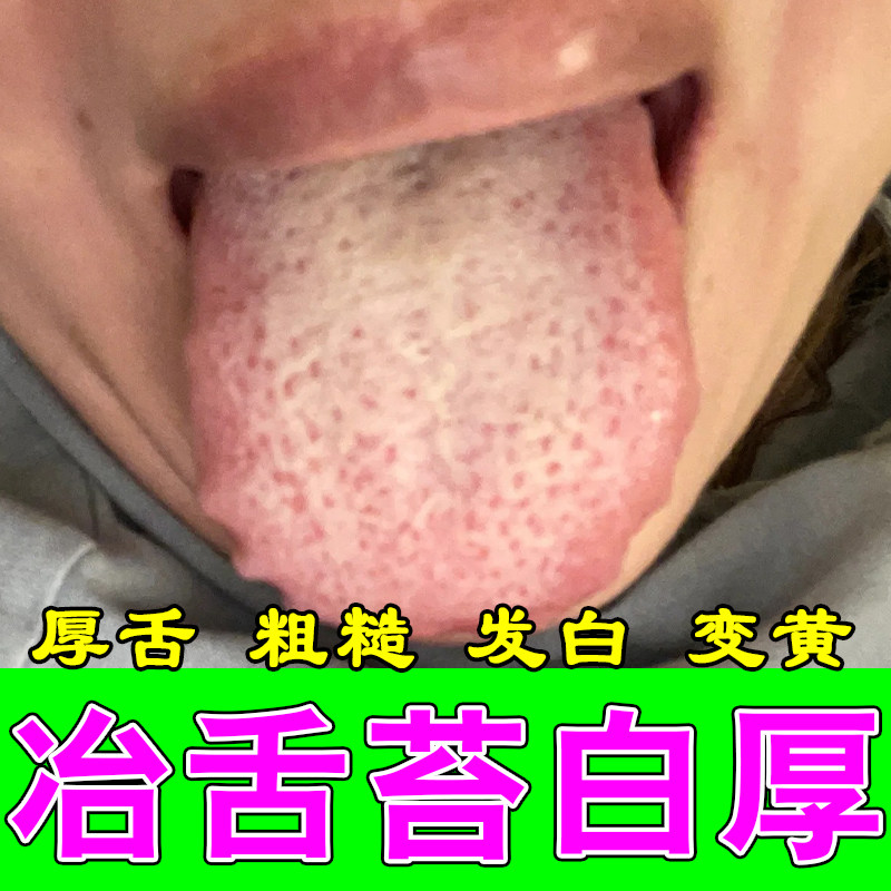 舌苔白厚口臭长期口气重舌头发白湿热白腻植物萃取修护保湿喷剂