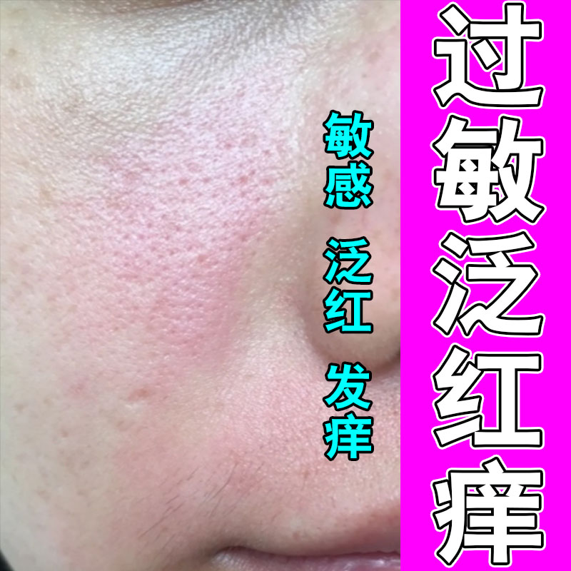 脸蛋敏感红肿发痒脱皮灼热春秋泛红不适植萃精华修护软膏