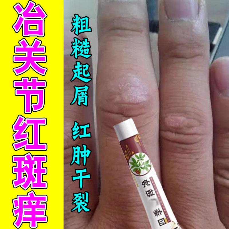 手指关节粗糙脱皮真菌起红斑鳞屑长硬疙瘩起干燥皮痒红肿痒修护膏