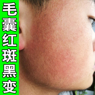 脸上起小疙瘩脸颊两侧小颗粒颈部毛囊红斑黑变病闭口粉刺