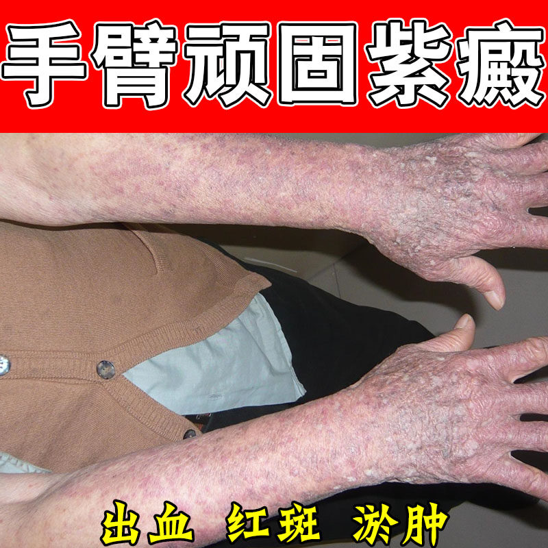 紫点皮下红点肌肤瘀斑暗沉色素过敏性癜外用护理膏