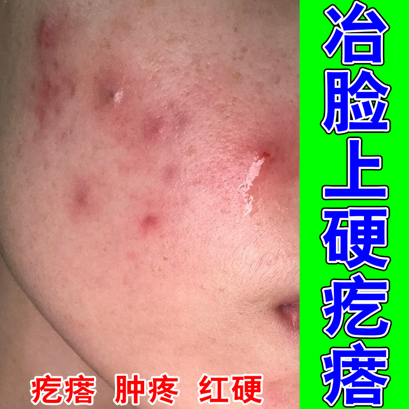 成人脸上起疙瘩红肿疼干燥脸上红肿硬疙瘩起皮修护舒缓软霜