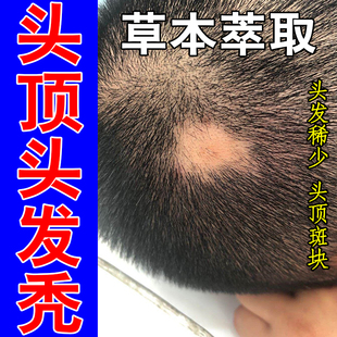 发量不足头顶疯狂掉发后脑勺露头皮发缝宽大稀薄增发护发草本喷剂