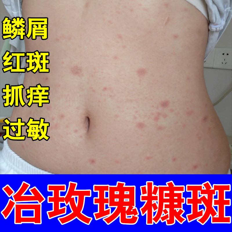 玫瑰红斑皮肤红痒起红斑起皮干燥大片红斑过敏刺挠草本修护软膏