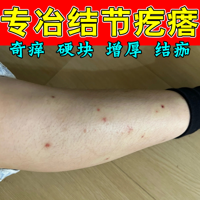 结节性疙瘩顽固皮肤硬块红斑疙瘩痒成片结痂红修护草本膏