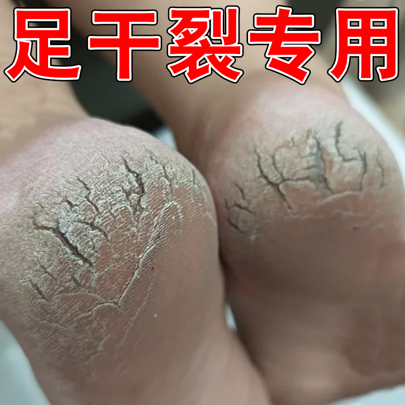 治脚裂脚后跟足跟干裂开裂皲裂去死皮起硬皮脱皮膏修复霜