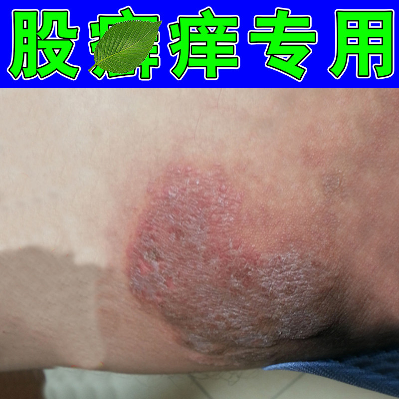 大腿根痒湿痒长红斑大腿内侧私处皮肤屁股根去专用膏