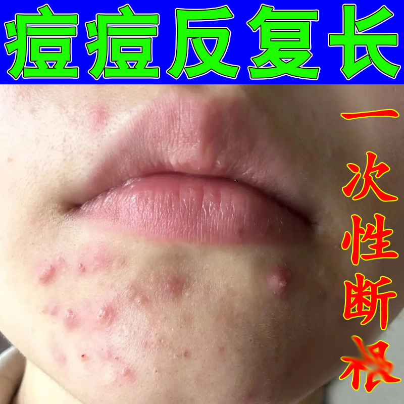 下巴反复长痘粉刺脓包闭口硬块