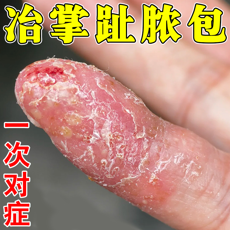 掌趾脓疱病症专用药掌跖角化症治疗手脚脓包红斑干裂脱皮粗糙外膏