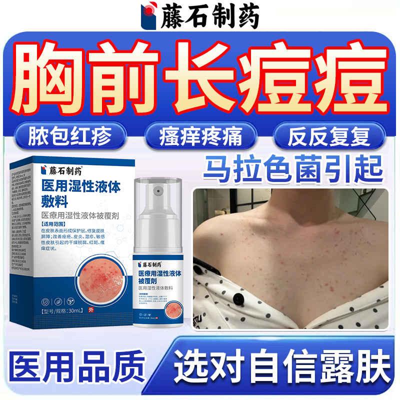 胸前长痘痘马拉色菌毛囊炎胸前后背疙瘩痒除螨祛痘医用级喷雾剂BS