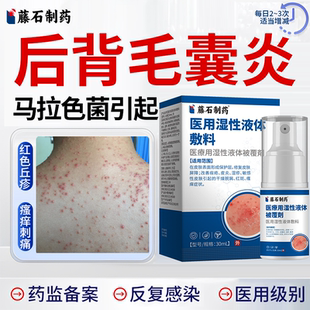 背后长痘痘后背马拉色菌毛囊炎前胸除螨祛红痘痒专用药监备案膏EM