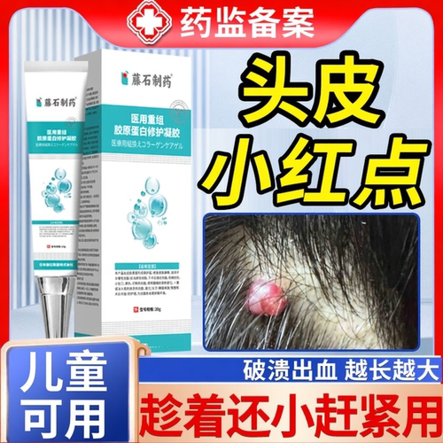 头皮血管瘤血管痔去除普萘洛尔膏